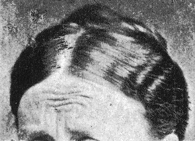 Tiedosto:Huolestuneen ryppyinen otsa.jpg